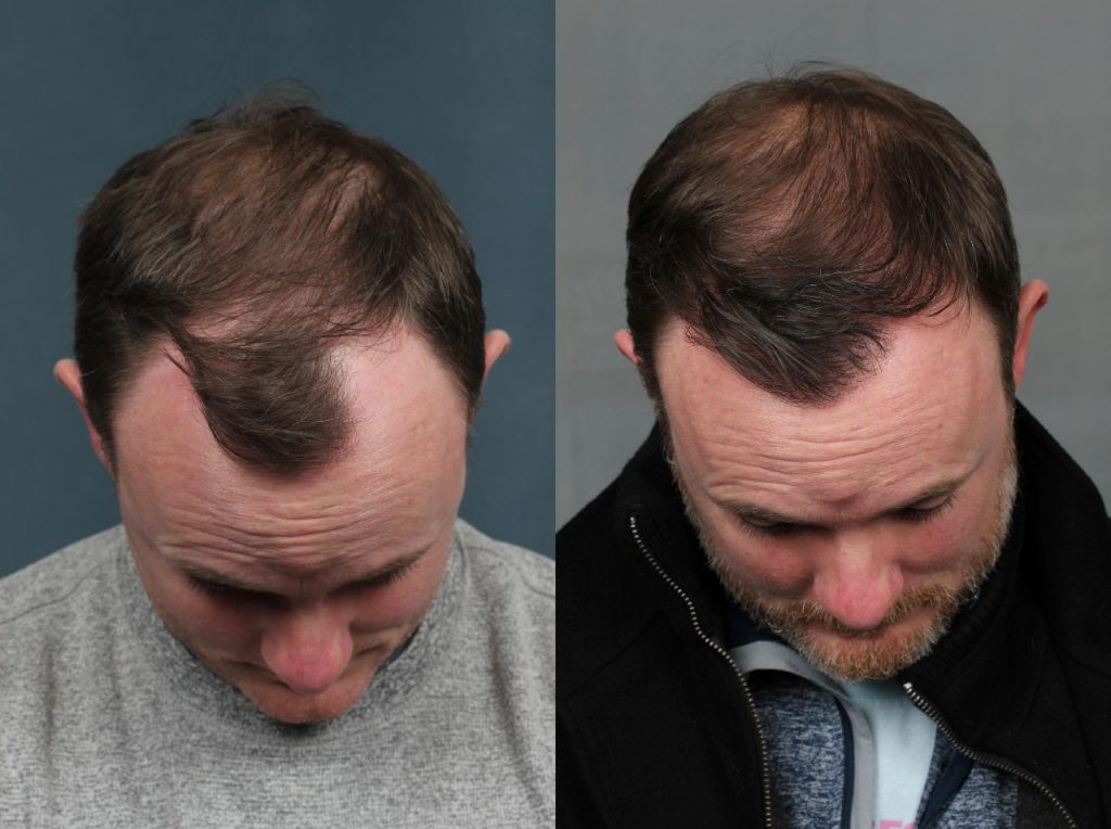Los Angeles Fue Hair Transplant Clinic