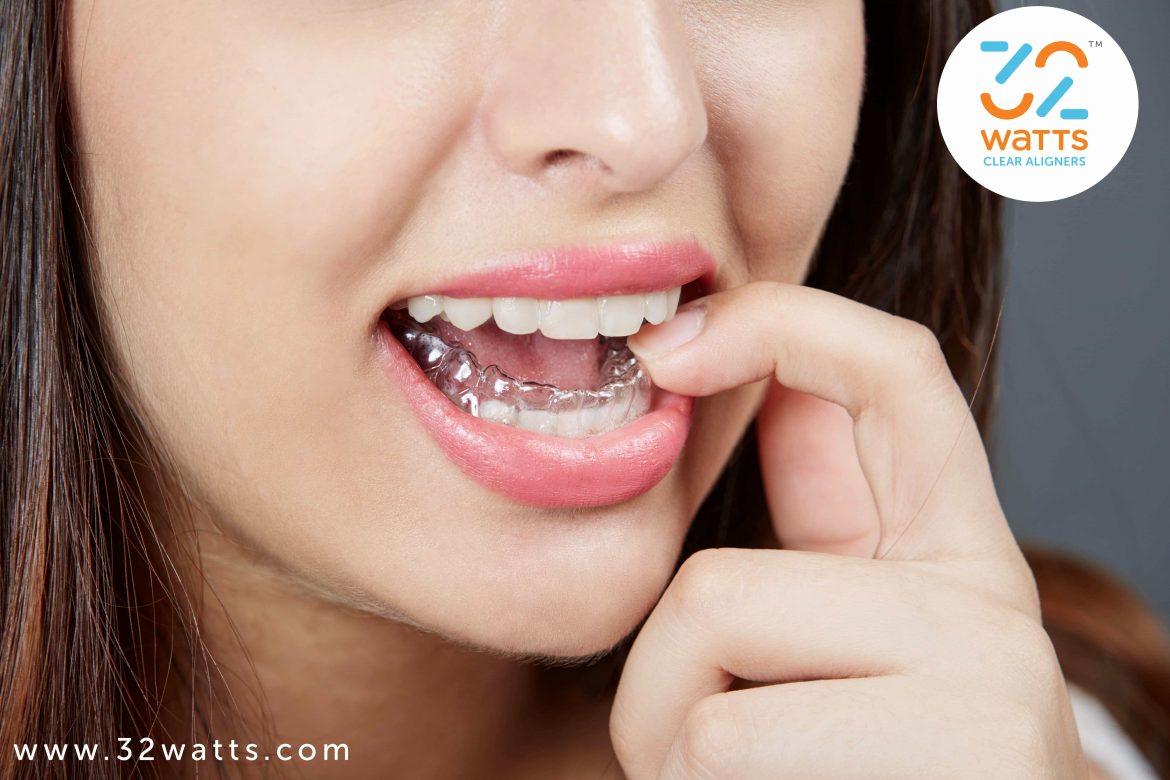 Invisible aligners cost in chennai invisible braces cost