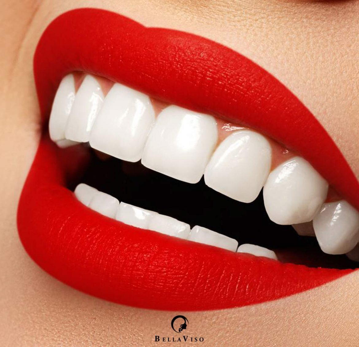porcelain veneers Dubai