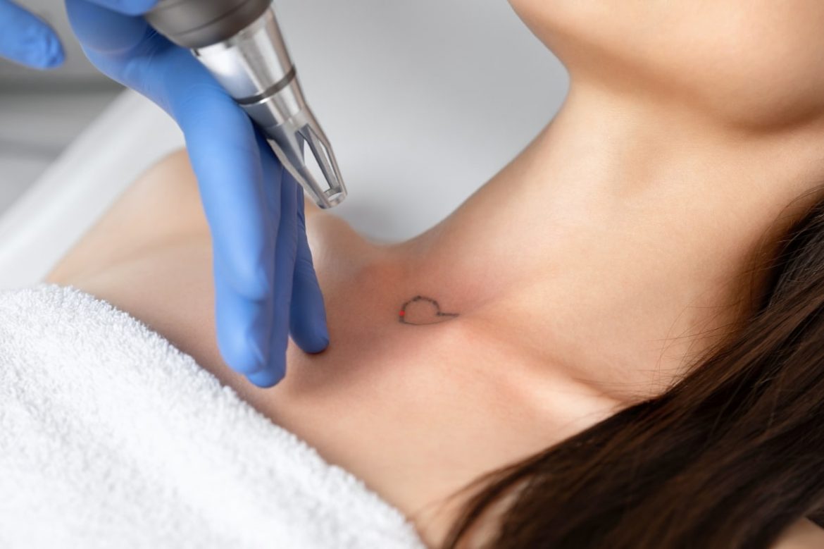 laser tattoo removal