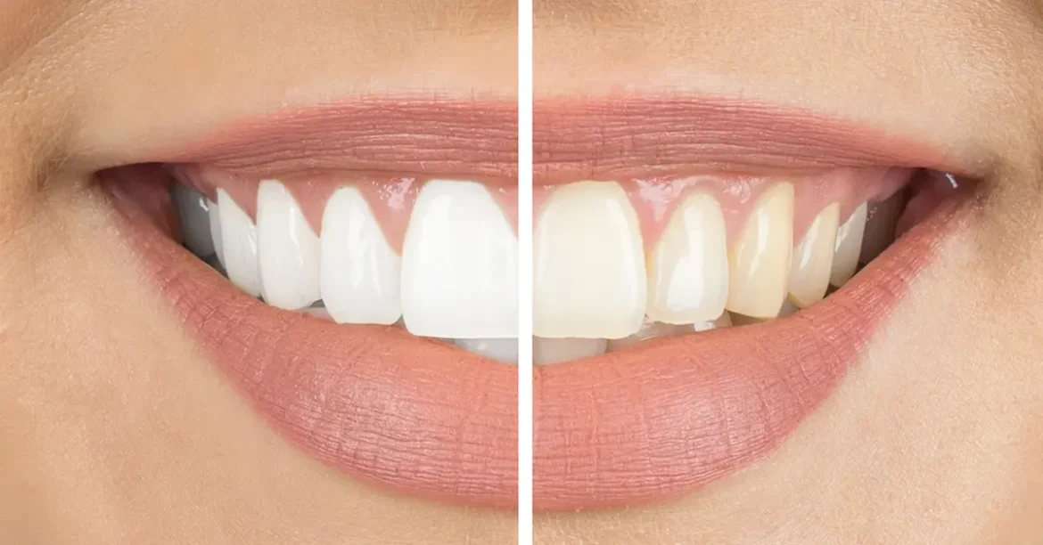 How-to-Get-White-Teeth-at-Home