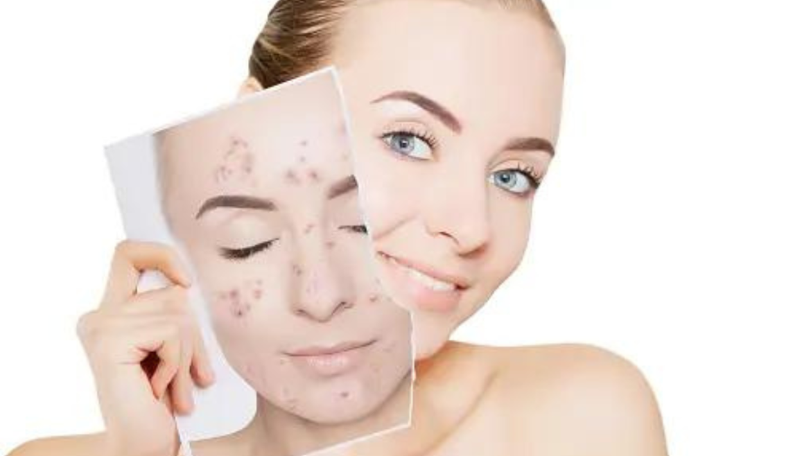 Must-Have Products for Oily and Acne-Prone Skin